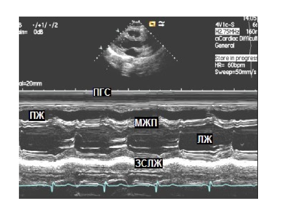 М режим. ЭХОКГ М режим. М-режим эхокардиографии. Измерения в м режиме эхокардиографии. Режимы ЭХОКГ.