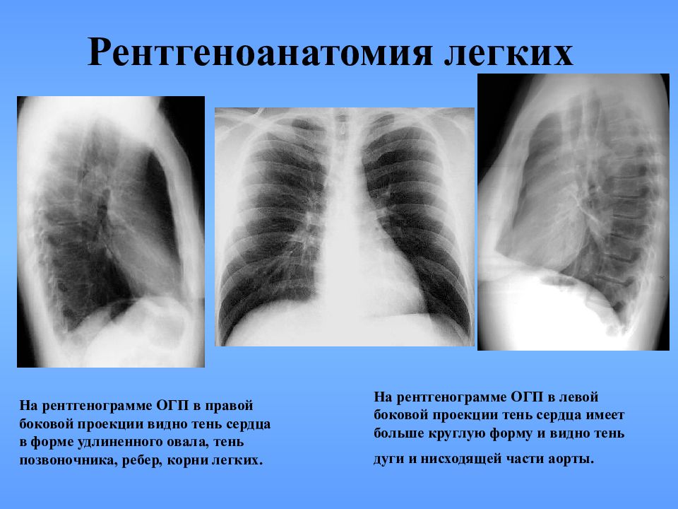 Рентген в двух проекциях. Рентген АНАТОМИЯЛЕГКИХ. Рентген анаиоммя легких. Ренгкнанатомия легких. Ренгенанатомия легкие.