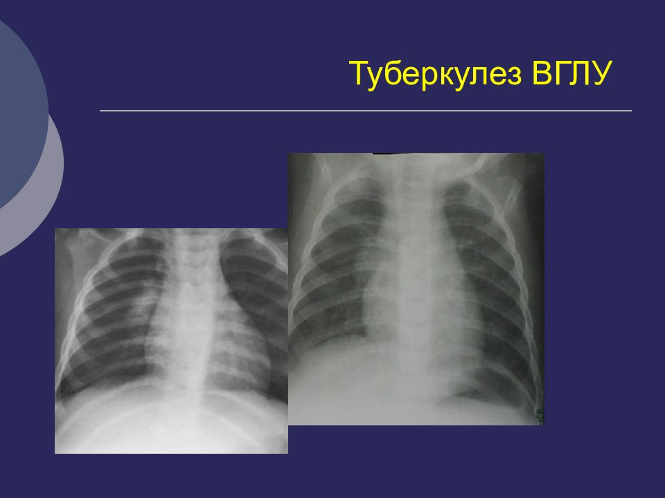 Туберкулез внутригрудных лимфатических узлов презентация