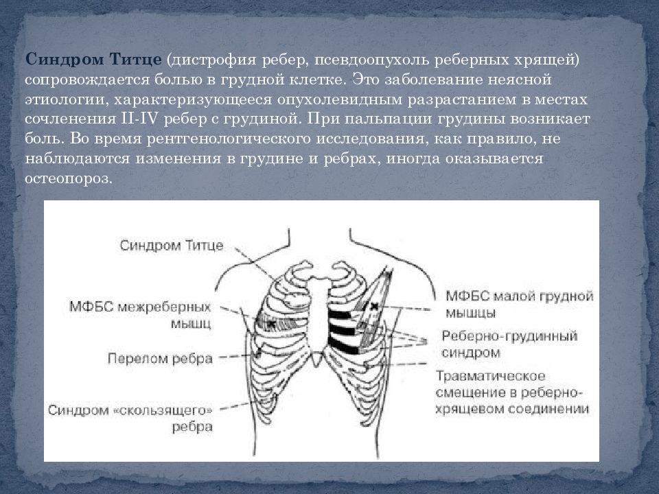 Боли грудной клетки после операции. Синдром Титце грудная клетка. Синдром Титце хондрит реберный. Болит верхний отдел грудной клетки спереди.