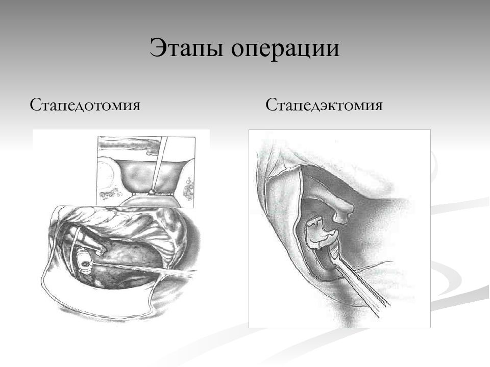 Стапедопластика. Отосклероз уха операция. Стапедэктомия при отосклерозе. Стапедопластика этапы операции. Отосклероз стапедопластика.