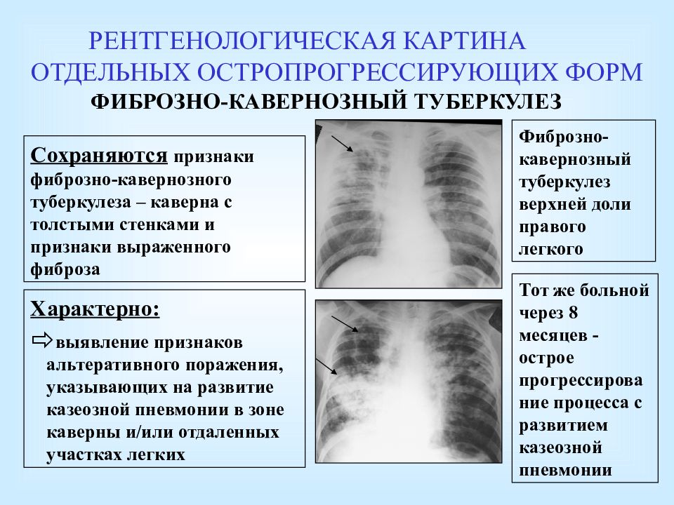 Рентген картина при фиброзно кавернозном туберкулезе легких характеризуется