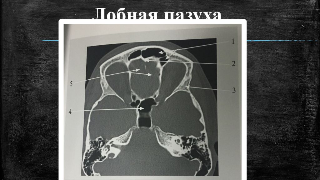 Лобная пазуха. Лобные пазухи анатомия рентген. Стенки лобной пазухи анатомия. Анатомия лобной пазухи кт.