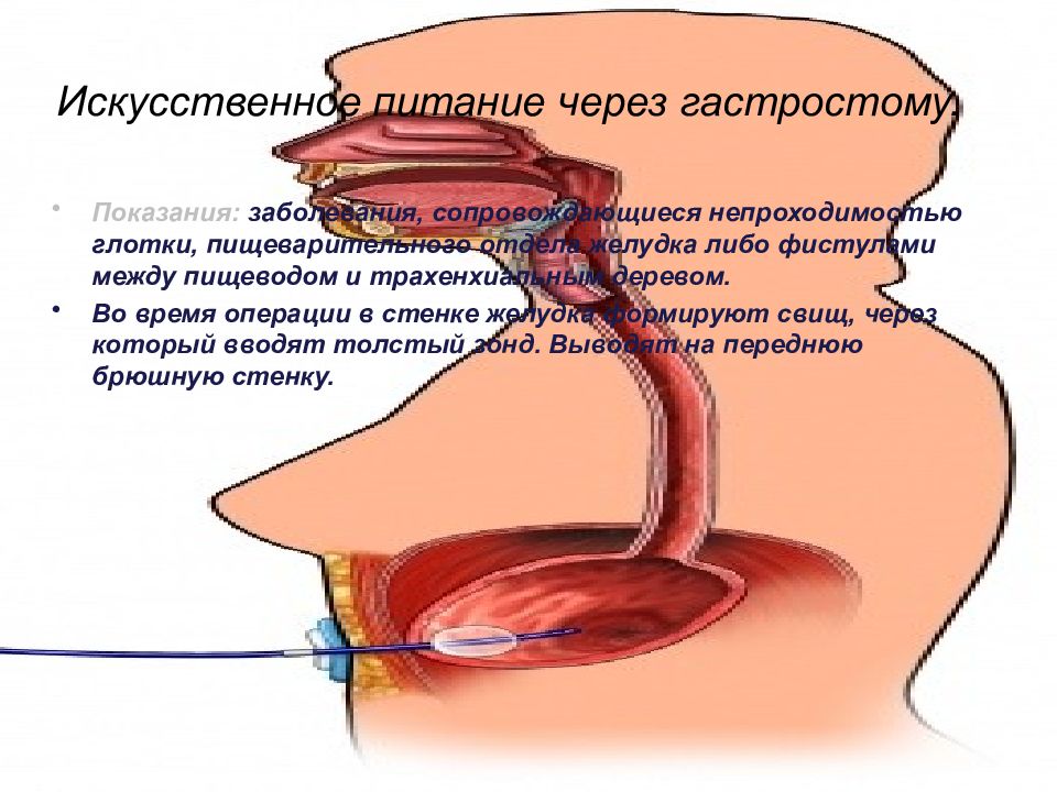 Питание через. Питание через гастростому. Показание к кормлению пациента через гастростому. Искусственное питание через гастростром. Показания к питанию через гастростому.