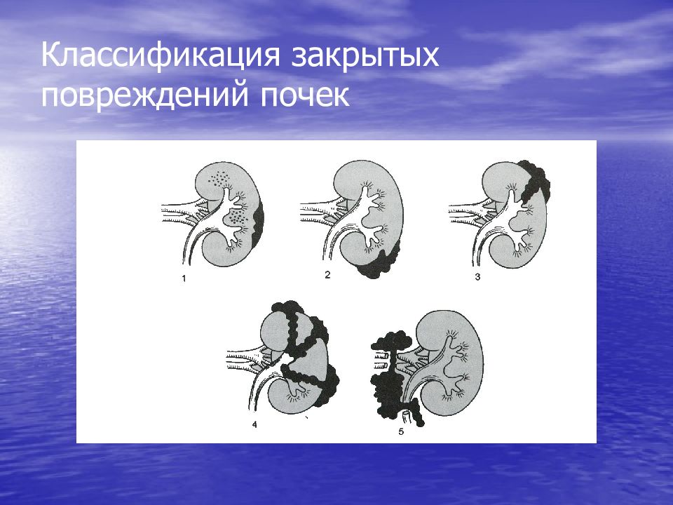 Травмы органов мочевыделительной системы презентация