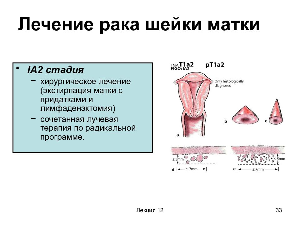 Рак шейки матки онкология презентация