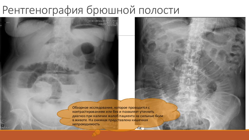 Рентгенография и рентгеноскопия