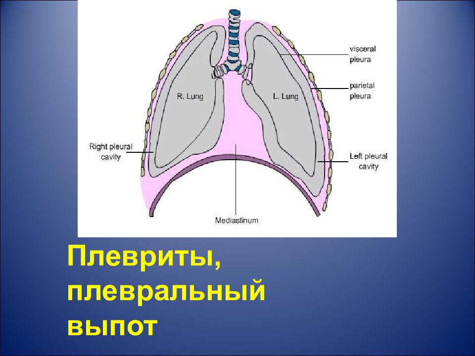 Плевральный выпот. Экссудат в плевральной полости. Выпот в плевральной полости.