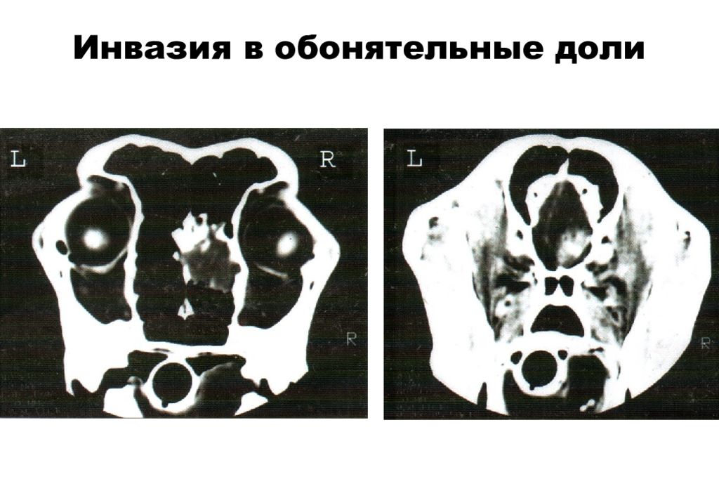 Кт лицевых костей. Кт лицевого отдела черепа. Компьютерная томография черепа. Компьютерная томография лицевого отдела черепа. Обонятельные луковицы мрт.