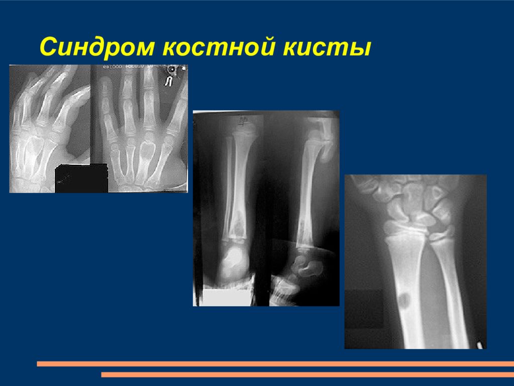 Костный синдром. Пястной кости рентген аневризмальная костная киста. Синдромы костно-суставной системы. Детский перелом название. Травматология детство.
