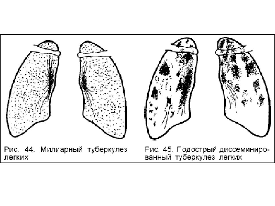 Милиарный туберкулез легких схема
