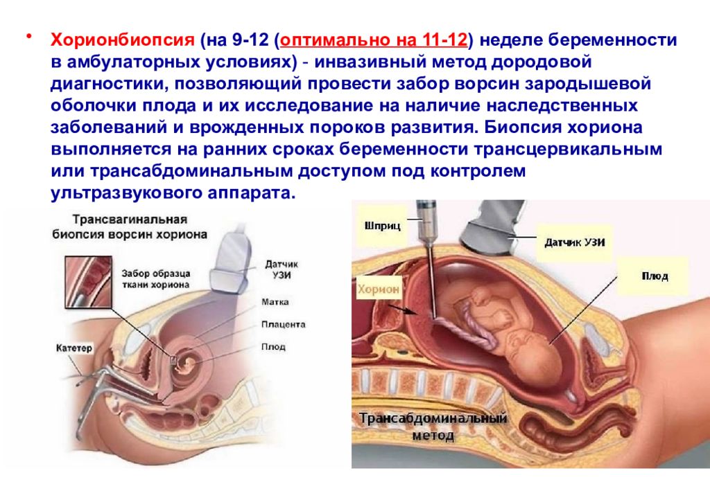 Биопсия ворсин хориона. Биопсия хориона амниоцентез кордоцентез. Трансцервикальная биопсия ворсин хориона. Пункция ворсин хориона. Хорион и плацентобиопсия объект исследования.