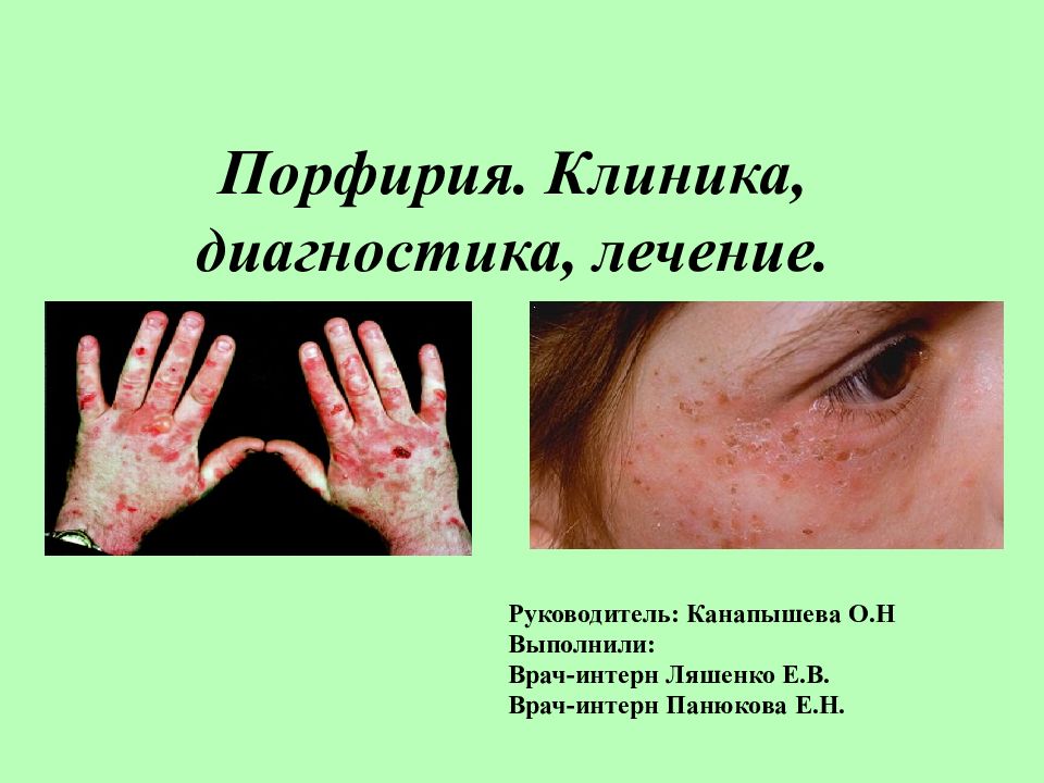 Порфирия. Клиника, диагностика, лечение.