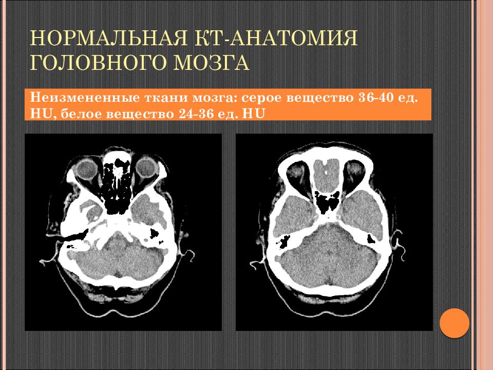 Кт анатомия. Кт головного мозга рентген анатомия. Кт анатомия головы. Нормальная кт анатомия головного мозга. Цистерны головного мозга на кт анатомия.