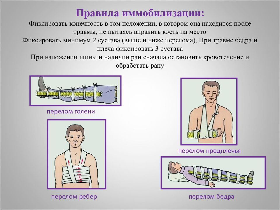 Первая помощь при переломах обж презентация