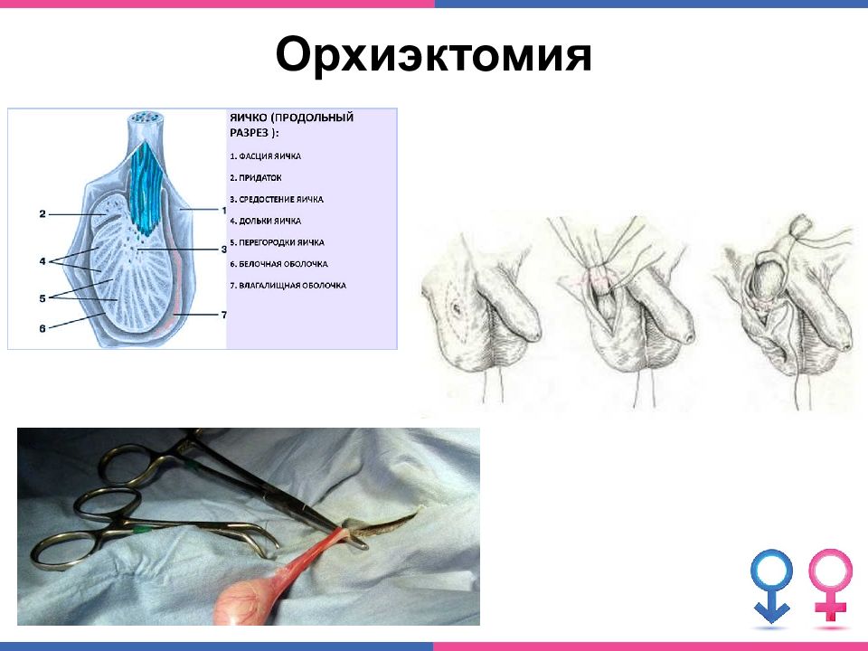 Имплант яичка. Операция по удалению яичек. Орхофуникулэктомия операция.