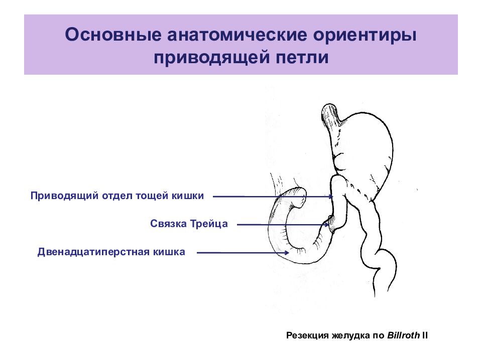 Отдел отвести. Приводящая петля кишки. Приводящий и отводящий отдел кишки. Приводящая петля кишечника это.