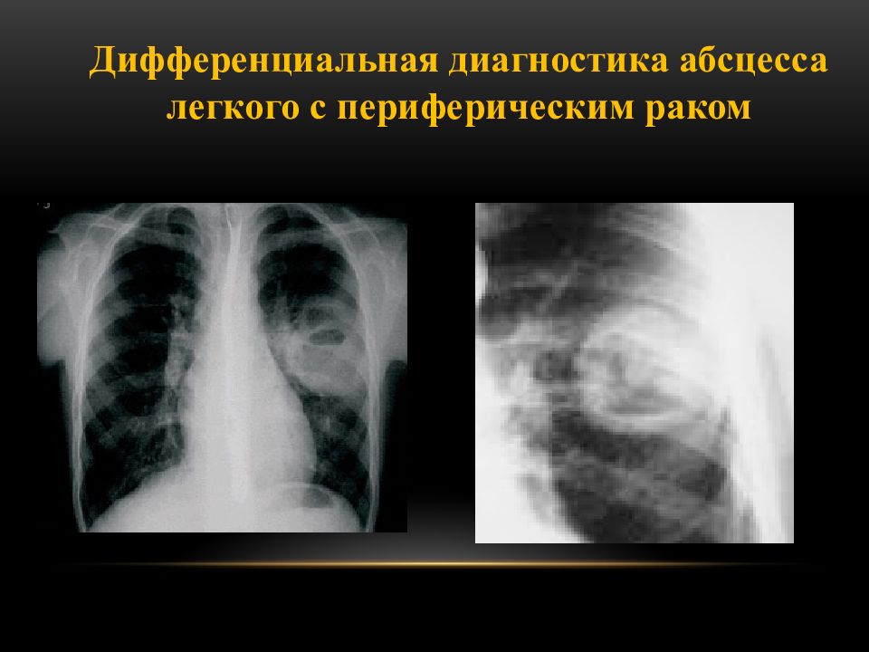 Диагноз периферический рак. Абсцесс лёгкого дифференциальная диагностика. Дифференциальная диагностика пневмонии и абсцесса легкого. Центральный и периферический абсцесс легкого.