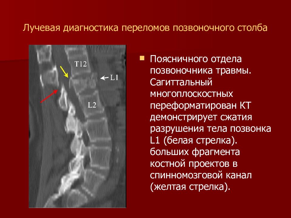 Диагноз перелом. Позвоночный канал 11 мм Сагиттальный размер. Стеноз 5 мм поясничного отдела позвоночника. Перелом поясничного позвонка кт. Сагиттальный размер тела позвонка.