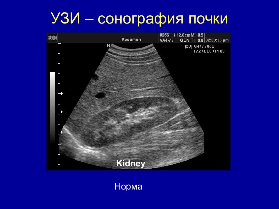 Нормальная почка. Ультразвуковые исследования(сонография ) почек. УЗИ почек сонограмма. УЗИ почек показатели нормы. Сонограмма почки.