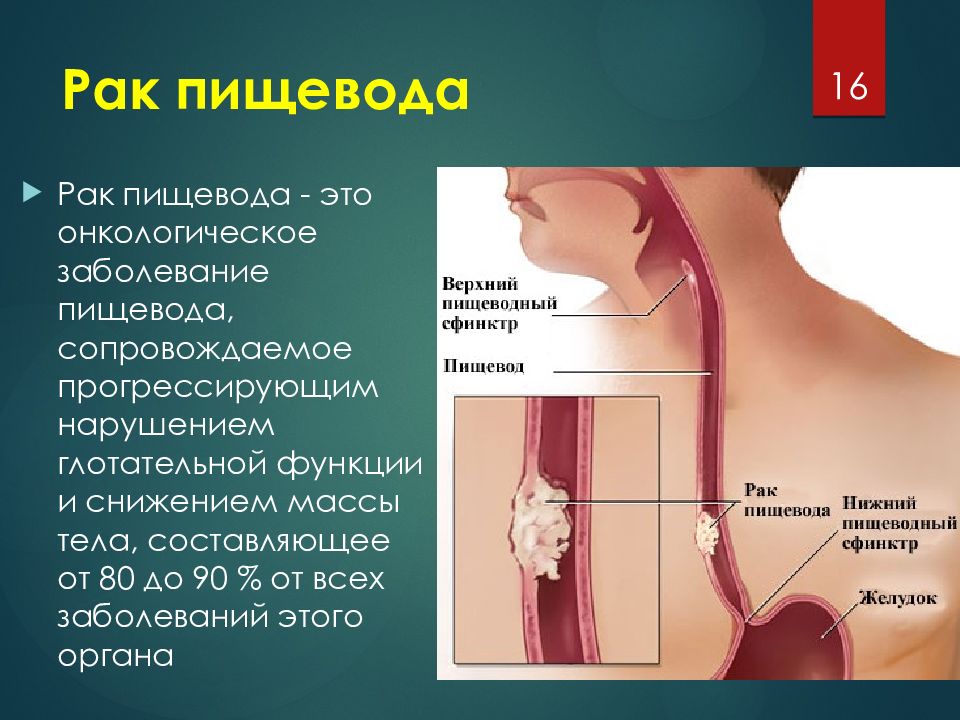 Клиническая картина эзофагита включает все перечисленное исключая