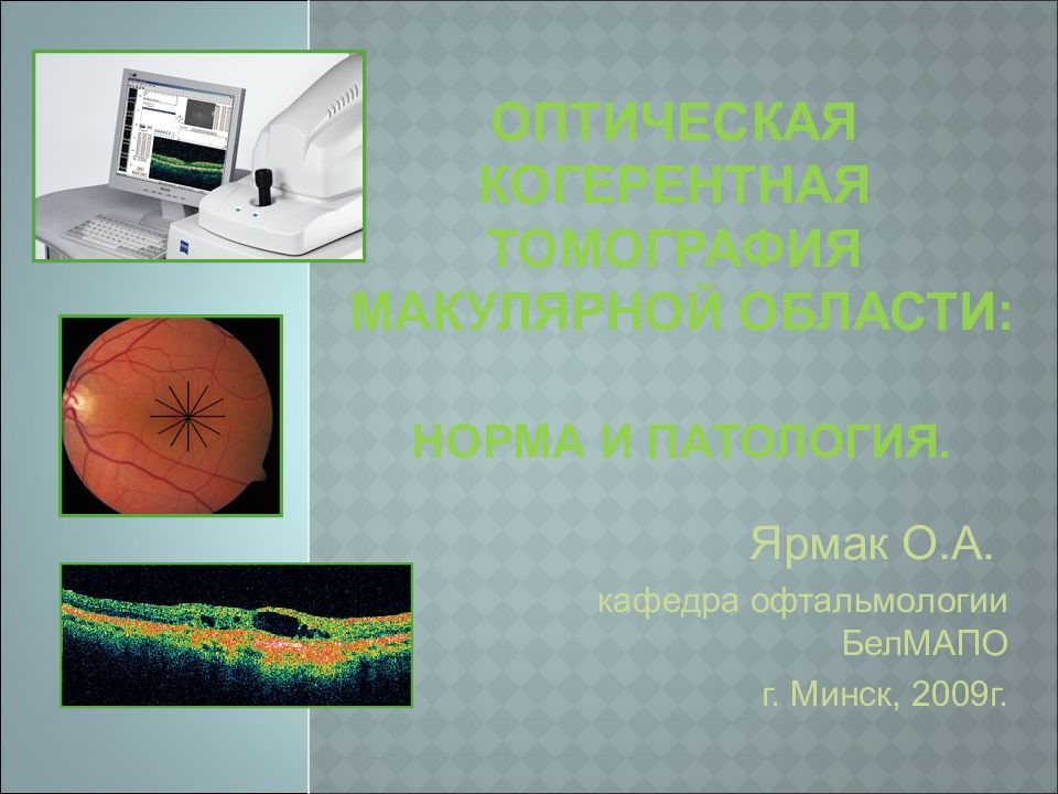 ОПТИЧЕСКАЯ КОГЕРЕНТНАЯ ТОМОГРАФИЯ МАКУЛЯРНОЙ ОБЛАСТИ: НОРМА И ПАТОЛОГИЯ.