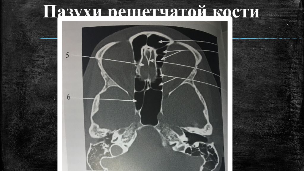 Стенки основной пазухи анатомия кт