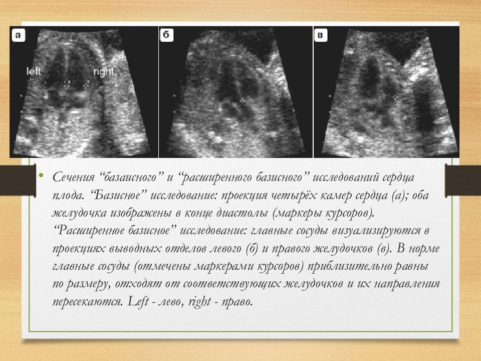 Диабетическая фетопатия презентация