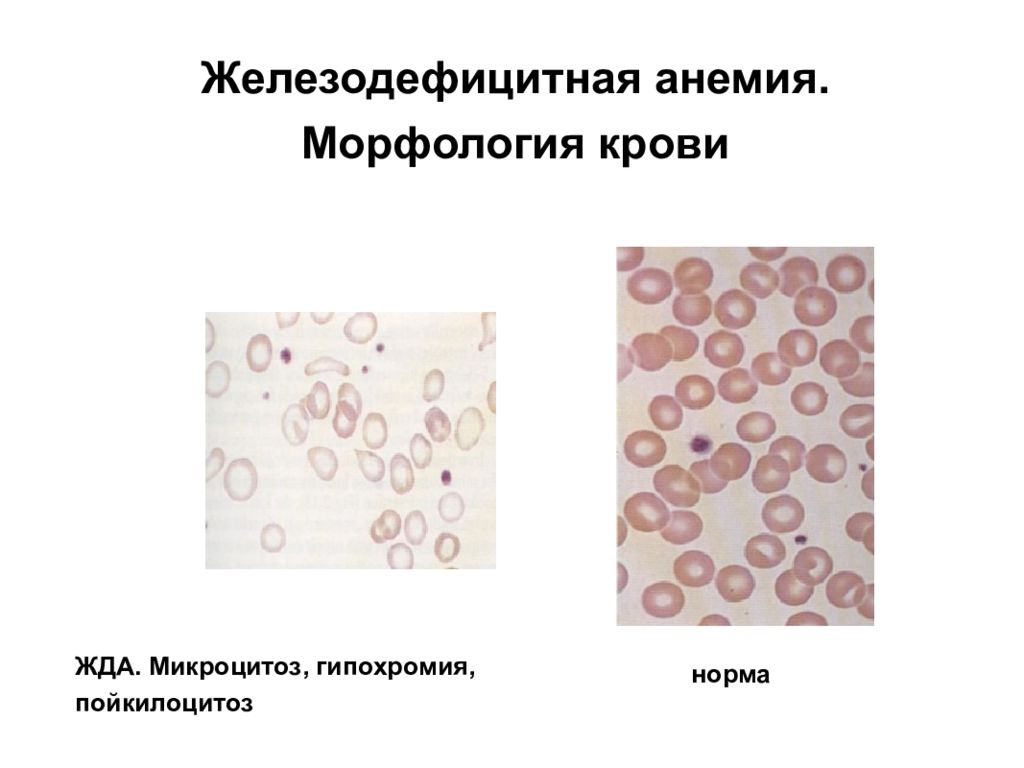 Анемия и эритроциты в крови. Морфология эритроцитов при жда. Морфология крови при железодефицитной анемии. Эритроциты при железодефицитной анемии. Анемия гипохромия микроцитоз.