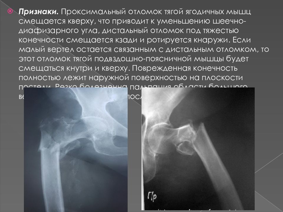 Переломы бедра презентация