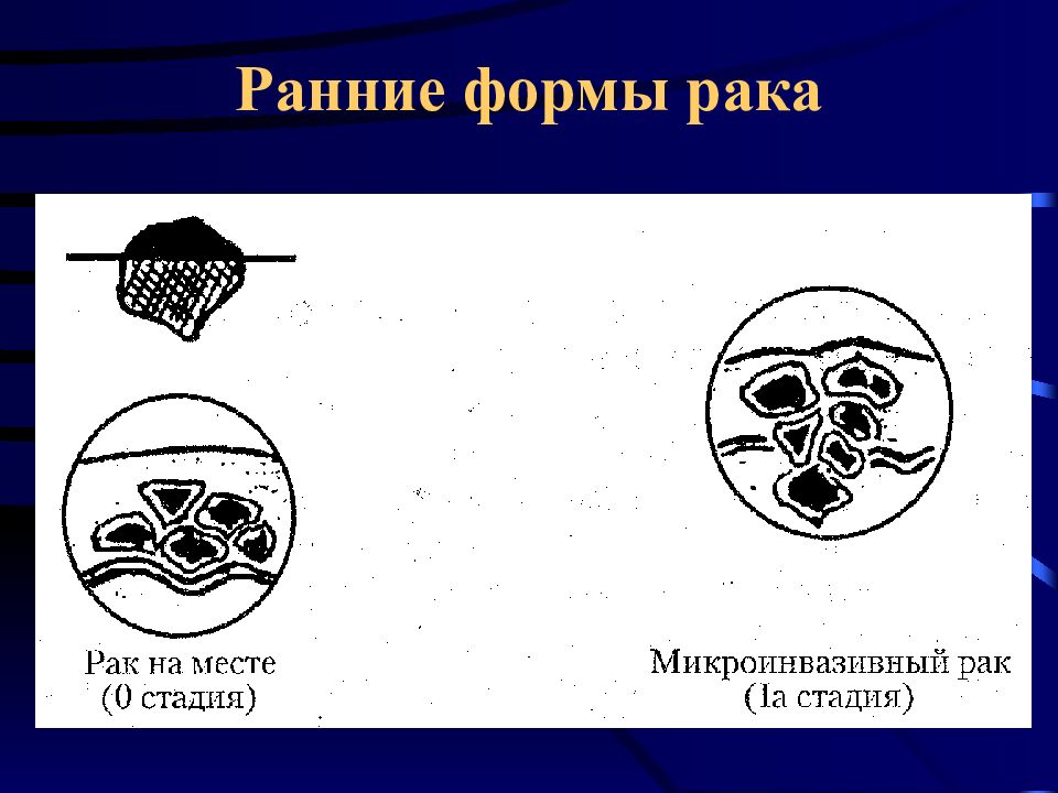 Формы рака