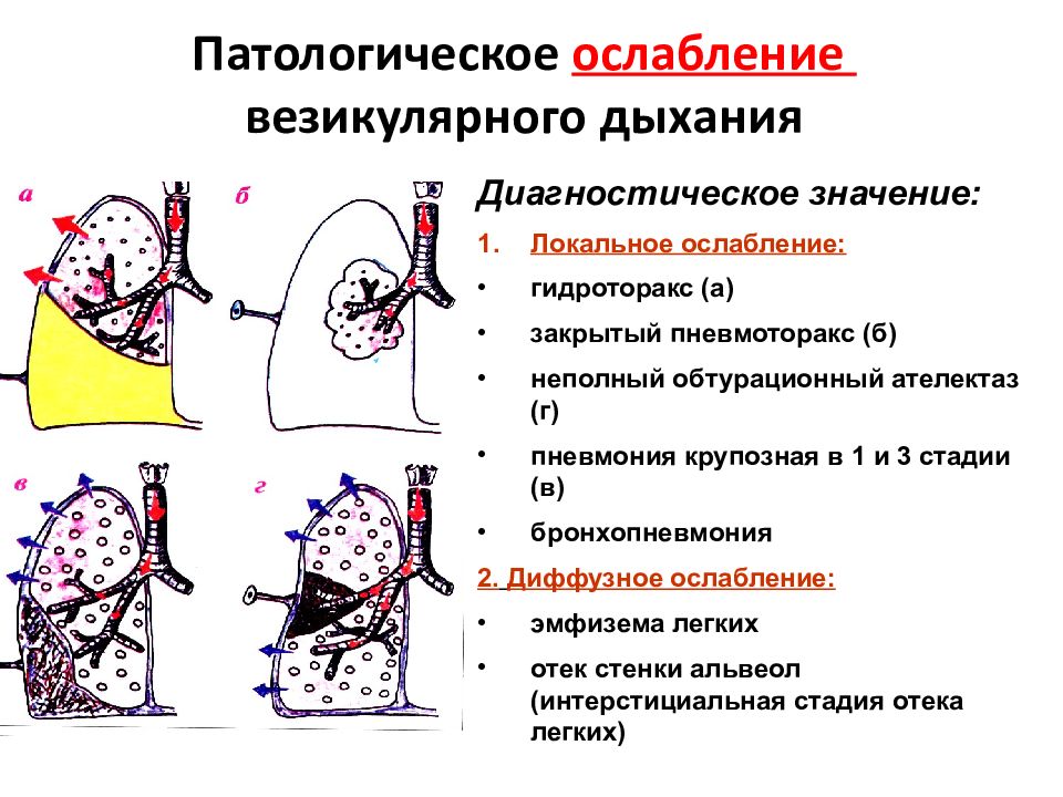 Ослабленное везикулярное дыхание схема