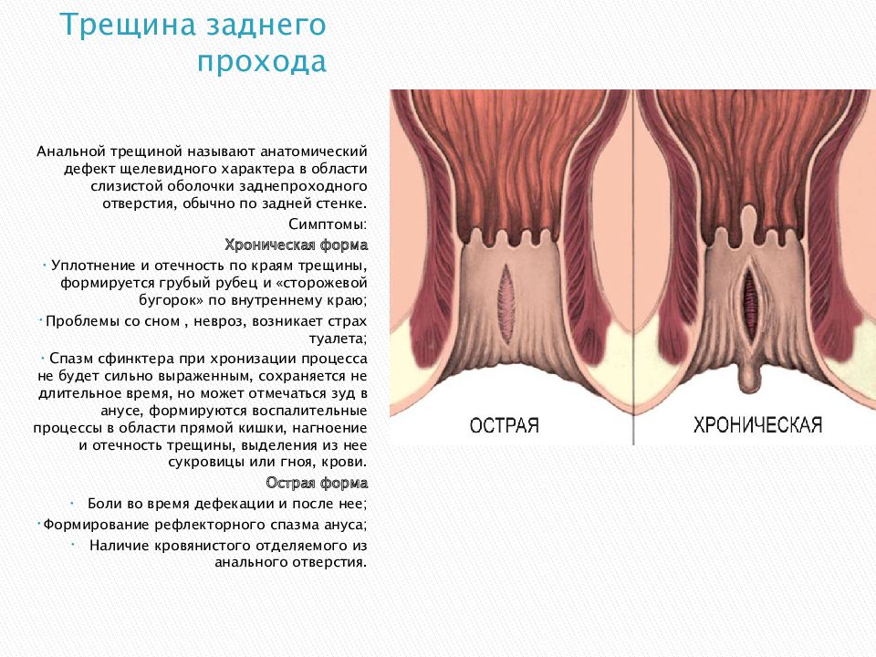 Трещины заднего прохода презентация