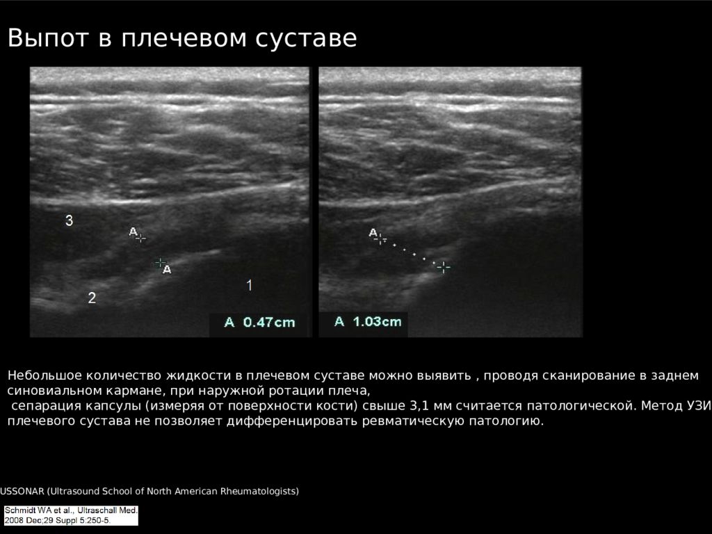Узи сочленения. Синовит плечевого сустава на УЗИ протокол. УЗИ плечевого сустава протокол. Протокол УЗИ плечевого сустава норма. УЗИ плечевого сустава норма.