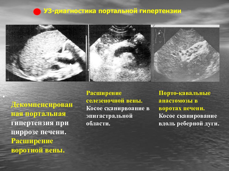 ультразвуковая допплерография печени. ультразвуковые критерии портальной гипертензии:. узи воротной вены при портальной гипертензии. признаки портальной гипертензии на узи брюшной полости. синдром портальной гипертензии узи.