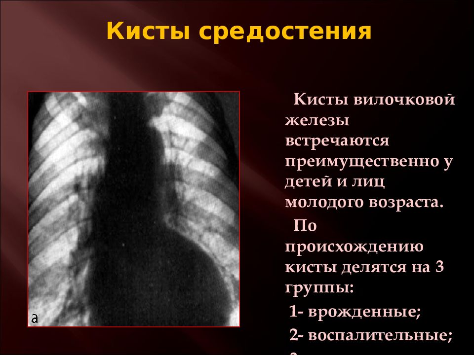 Опухоли средостения презентация