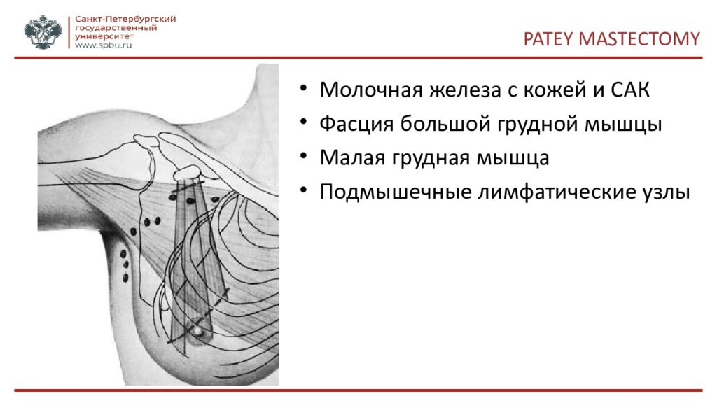 Сторожевой узел при раке молочной железы