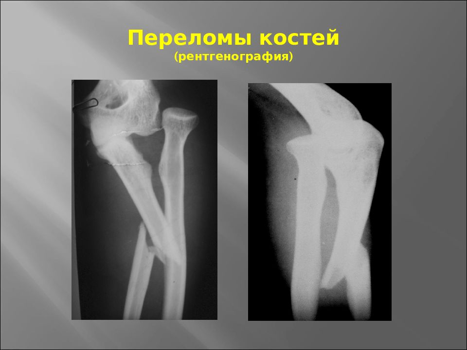 Травматология переломы презентация