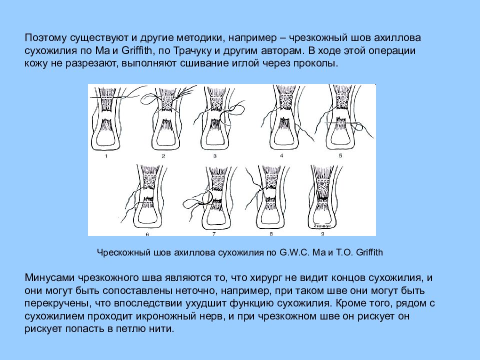 Презентация операции на сухожилиях