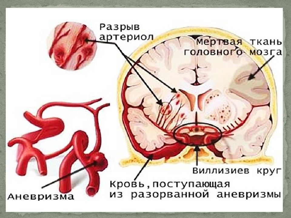 Аневризма головного мозга симптомы. Разрыв сосуда головного мозга. Разрыв аневризмы сосудов головного мозга. Разрыв аневризмы артерии головного мозга. Аневризмы сосудов головного мозга классификация.