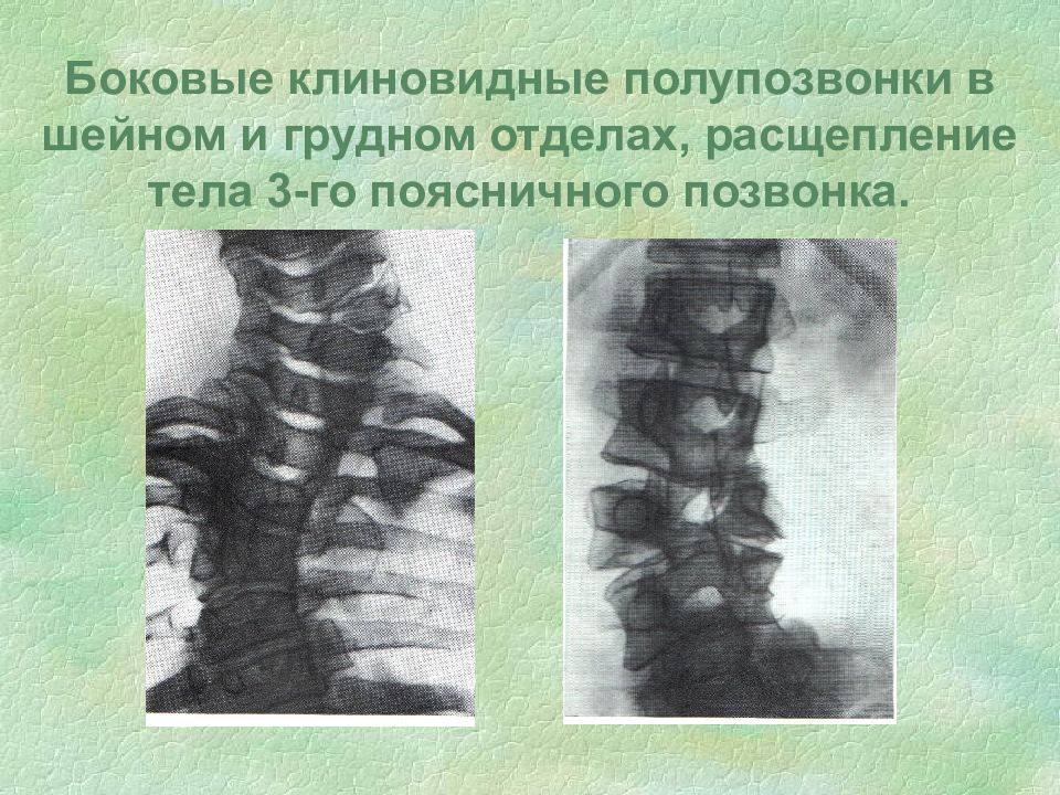 Пороки развития опорно двигательного аппарата презентация