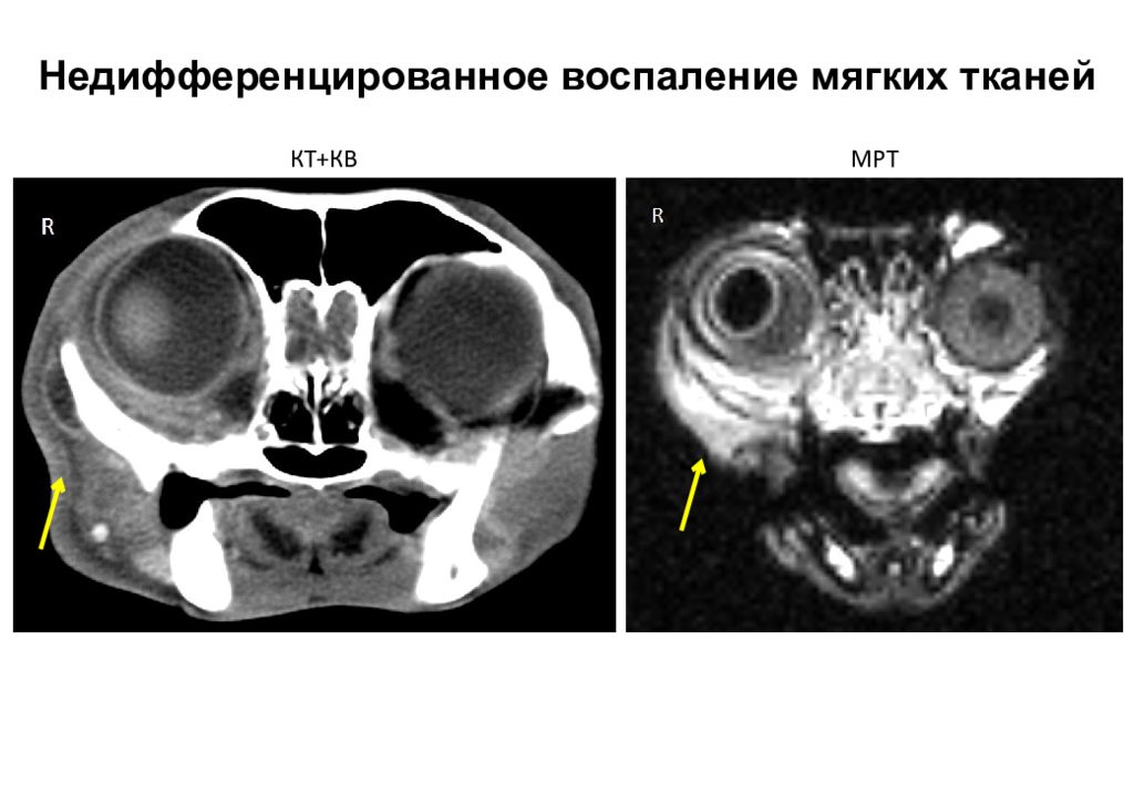 Кт тканей. Компьютерная томография МОПСА. Мягкие ткани черепа кт.