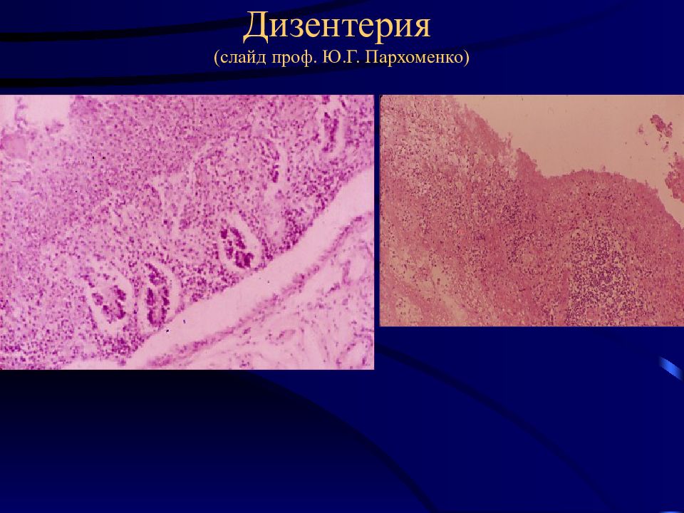 Дизентерия презентация патологическая анатомия