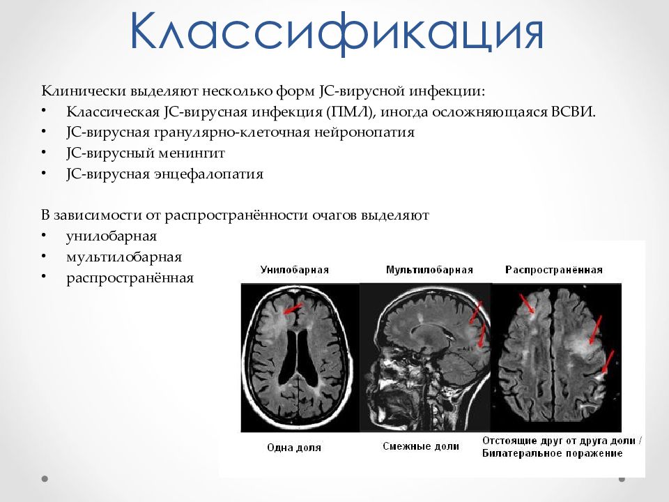 Лейкоэнцефалопатия кт картина