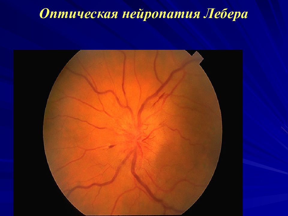 Нейропатия зрительных. Оптическая нейропатия зрительного нерва. Атрофия зрительного нерва Лебера. Оптическая невропатия Лебера. Наследственная оптическая нейропатия LHON Лебера.