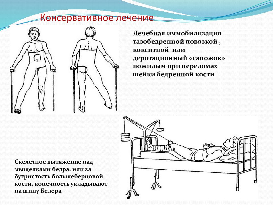 Послеоперационный период шейки бедра. Перелом шейки бедренной кости иммобилизация. Реабилитация при переломе шейки бедра план. Положение больного с переломом шейки бедра. Иммобилизация при переломе бедренной кости.