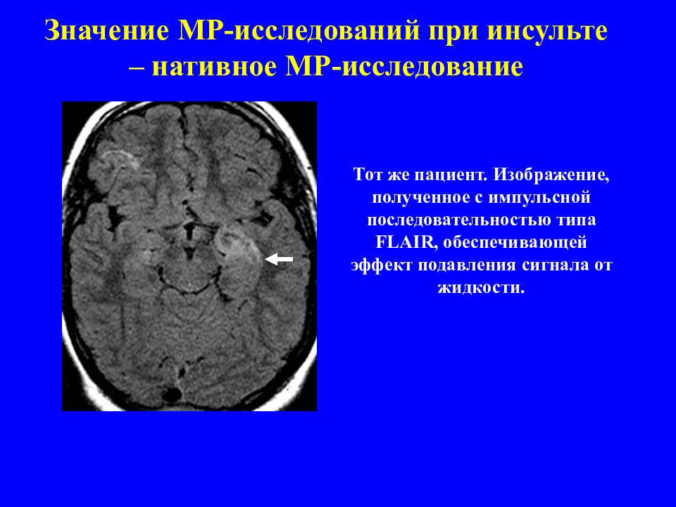 Стволовой инсульт прогноз