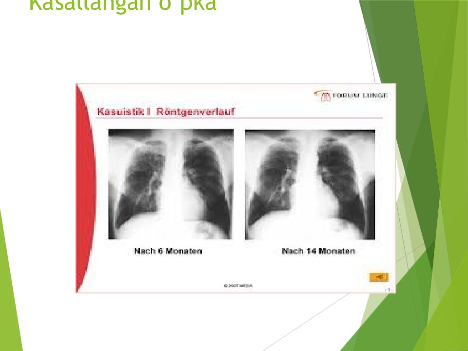O'PKA OBSTRUKTIV YETISHMOVCHILIGI DIAGNOSTIKASI Kasallangan o’pka