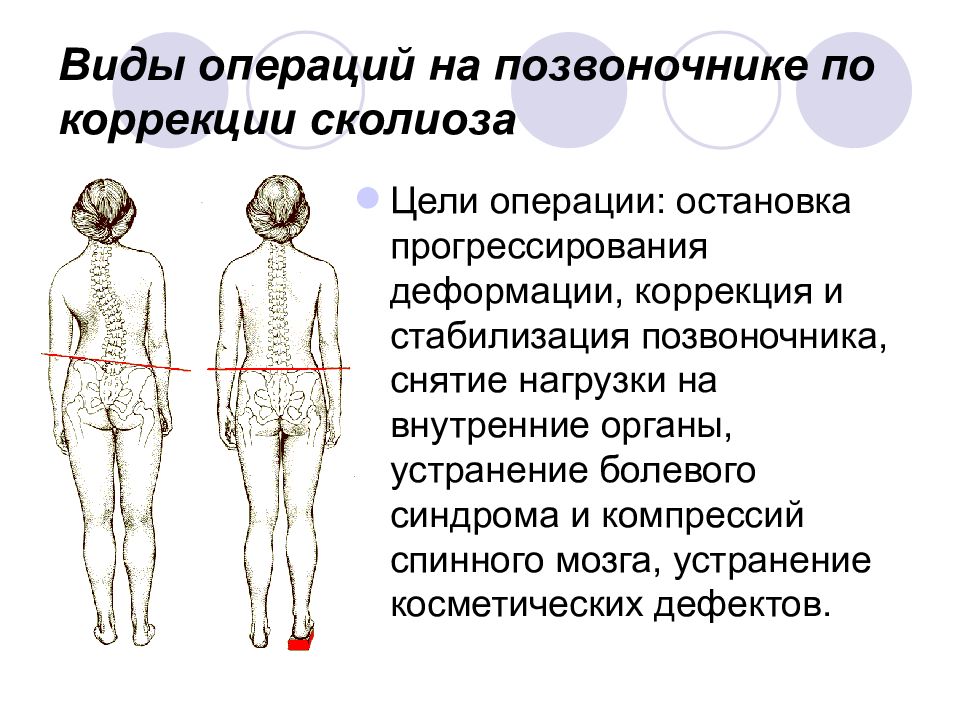 Хирургическое лечение сколиоза презентация