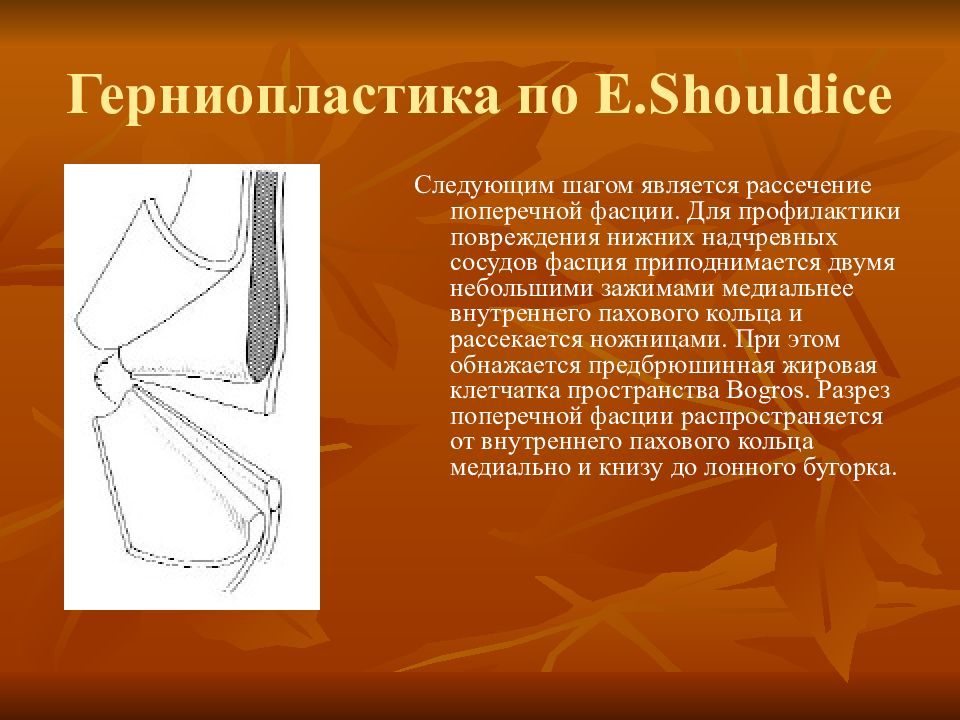 Герниопластика. Герниопластика по e.Shouldice. Герниопластики презентация.